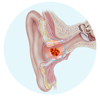 Tres factores que pueden influir en la producción de cerumen